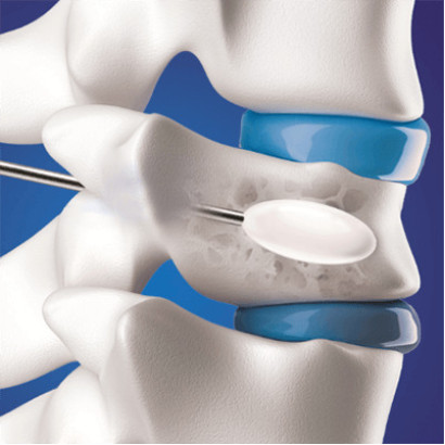 Tracker™ System for Kyphoplasty
