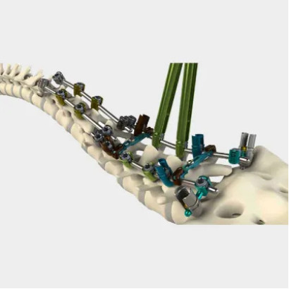 TiLock²™ Spinal System